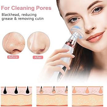 Electric Blackheads Remover